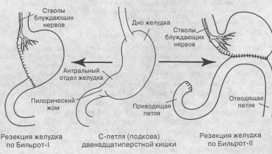 Что такое рак желудка?