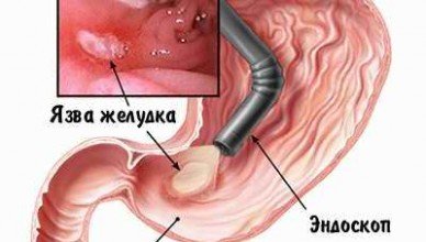 Как лечится язва желудка?