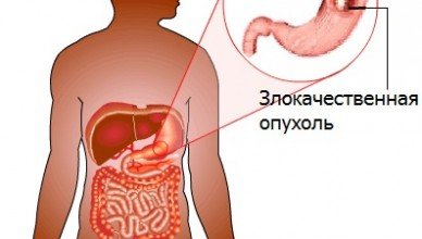 Симптомы и лечение лейомиомы желудка