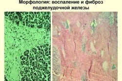 Воспаление и фиброз